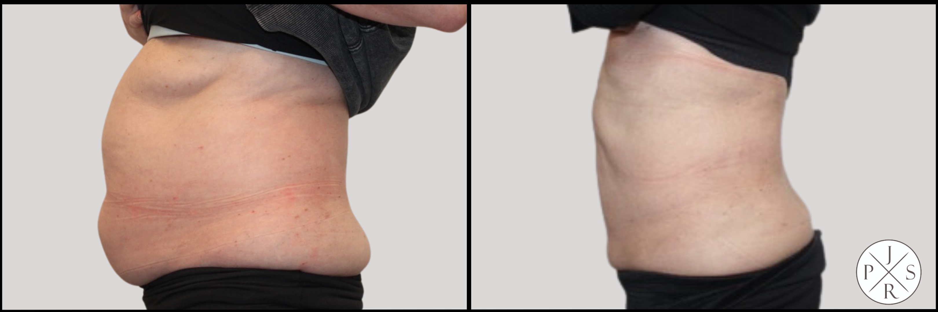 Liposuction Before & After Image